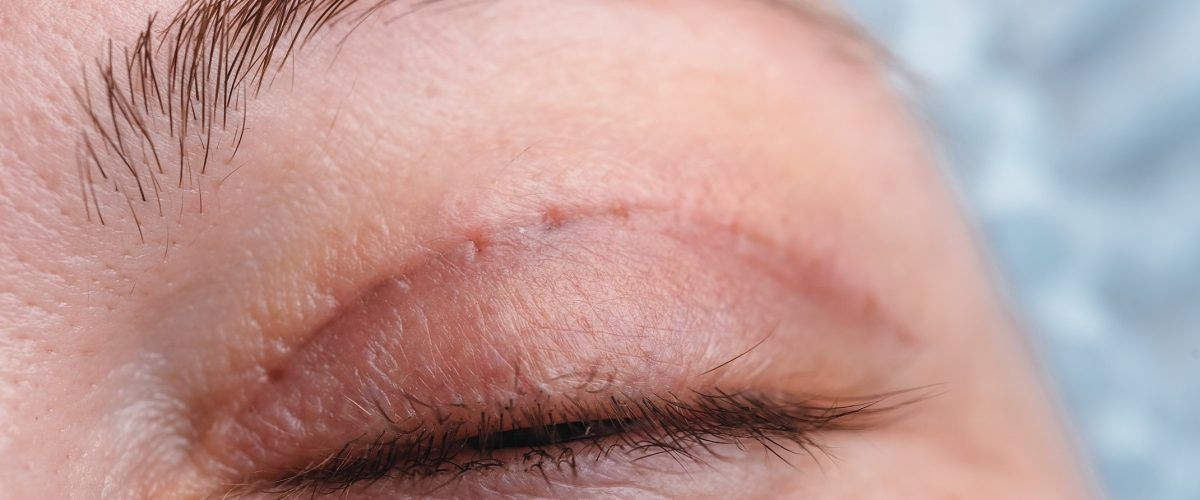 Blefaroplastia inferior e superior